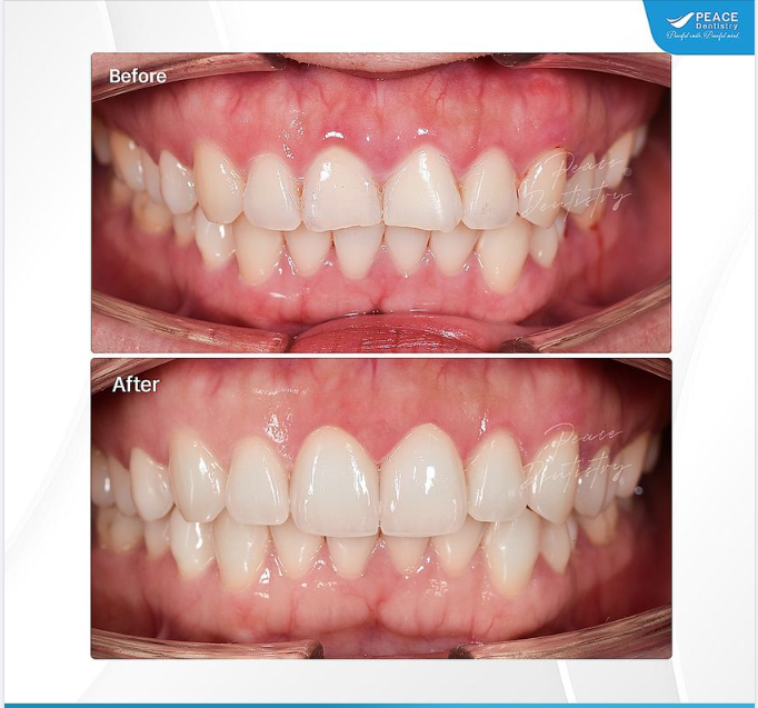 Ca lâm sàng thực hiện bởi BS. Đặng Hoàng Cương - Peace Dentistry Quận 7; Sử dụng vật liệu veneer IPS e.Max - hãng Ivoclar Vivadent; Thời gian hoàn thành: 3 ngày.