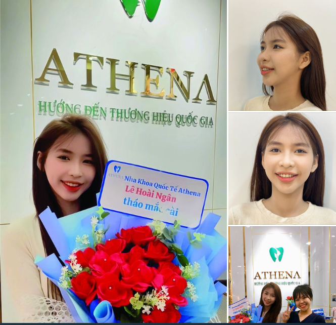 Tháo Niềng Răng Thành Công: Hành Trình Tự Tin Tới Năm 2024