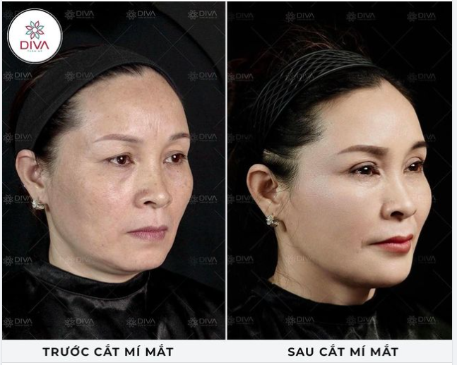 KẾT QUẢ THẨM MỸ MẮT 2 MÍ ĐỀU ĐẸP SAU CẮT MÍ MẮT