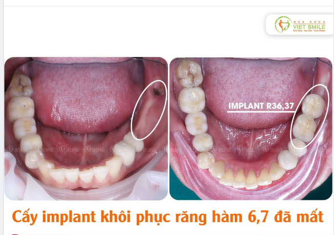 CẤY IMPLANT RĂNG HÀM ĐỂ ĂN NHAI TỐT HƠN