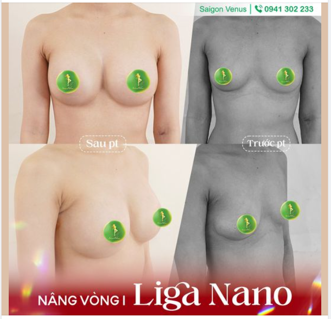 FEEDBACK NÂNG V1 LIGA NANO SIÊU HOT TẠI SAIGON VENUS
