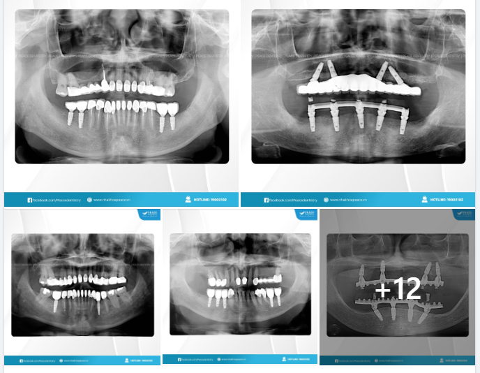 TÁI KHÁM IMPLANT