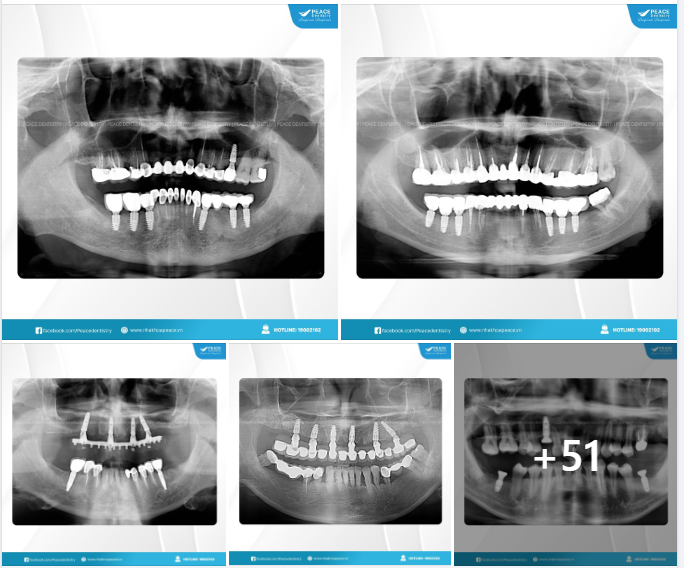 IMPLANT GALLERY - PEACE DENTISTRY (02/01/2024)