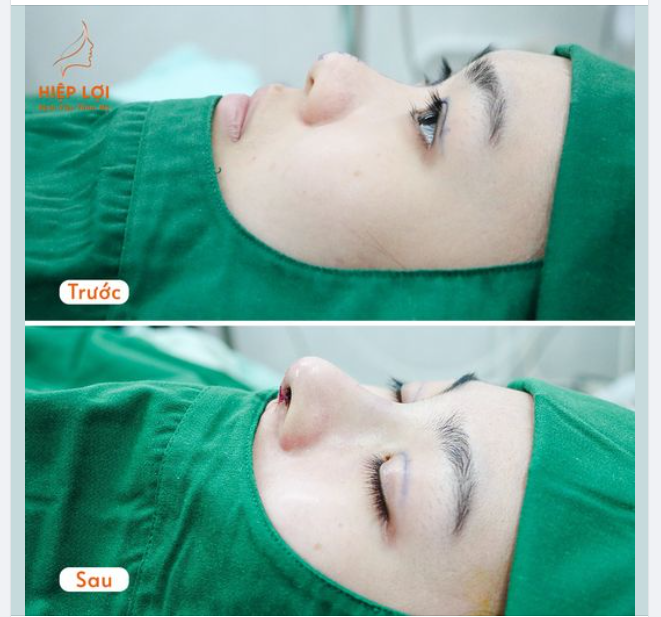 Dáng mũi cho chị em thích "TỰ NHIÊN" nhưng "RẤT SANG"