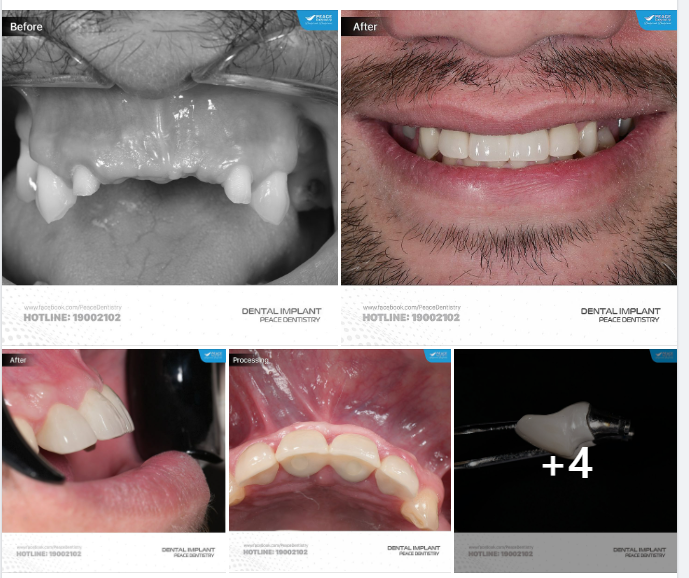 IMPLANT  GHÉP XƯƠNG & GHÉP NƯỚU | KHÁCH HÀNG QUỐC TẾ