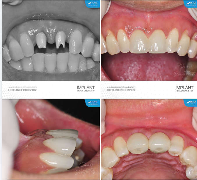  ZIRCONIA CUSTOMIZED ABUTMENT