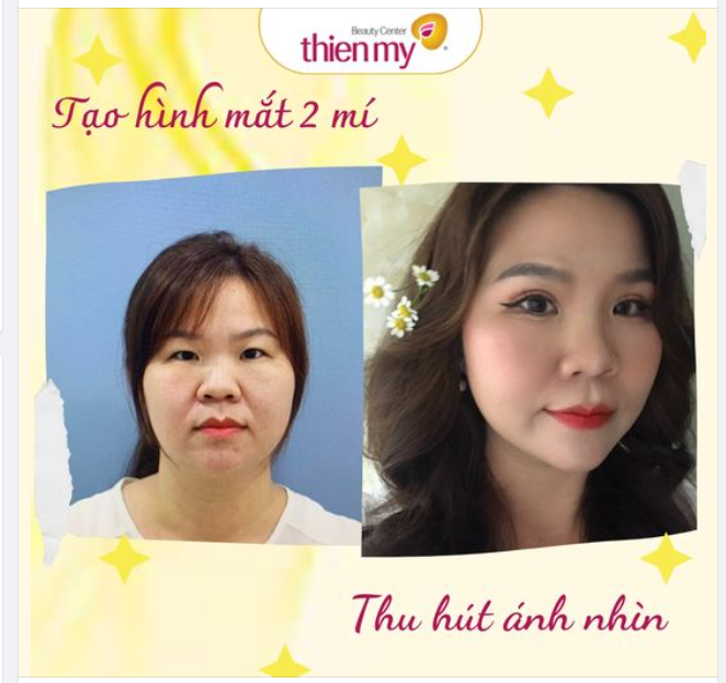 Kỹ thuật chuẩn xác từ bác sĩ: Xóa sổ da chùng, sụp mí. Tạo hình nếp mí đẹp, duy trì lâu dài