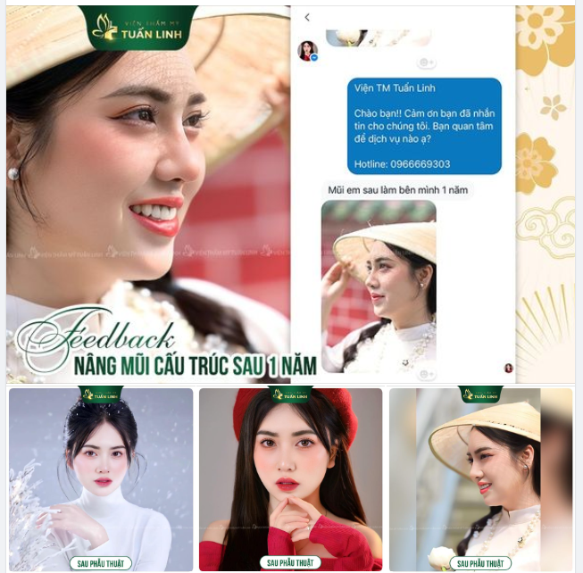 Feedback Mũi cấu trúc sau 1 năm nâng tại Tuấn Linh!!