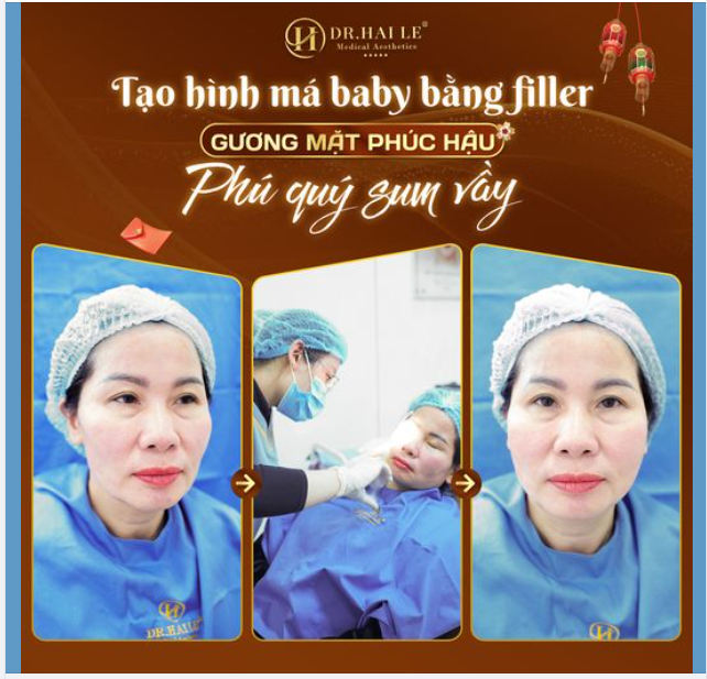 Chiếc má “phúng phính” đầy đặn sẽ giúp cho gương mặt trẻ trung hơn.