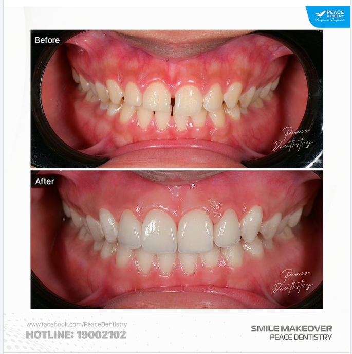 VENEER  CAN THIỆP TỐI THIỂU