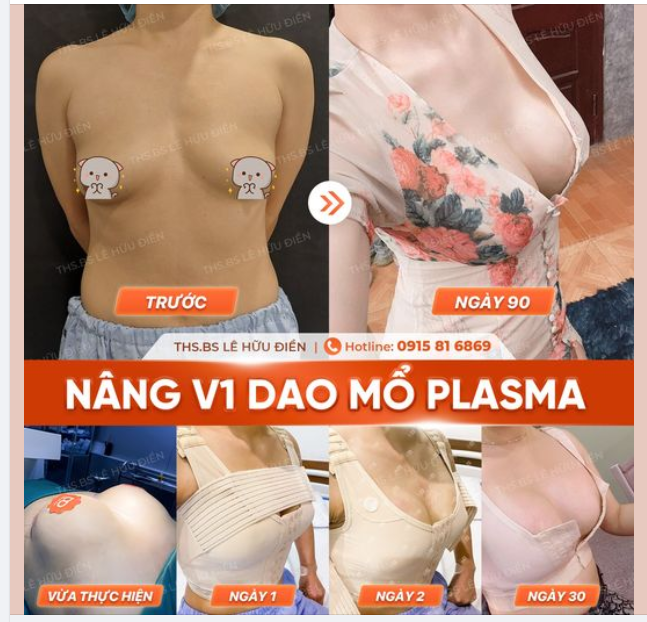NÂNG NGỰC SAU BAO LÂU MỀM MẠI, TỰ NHIÊN?