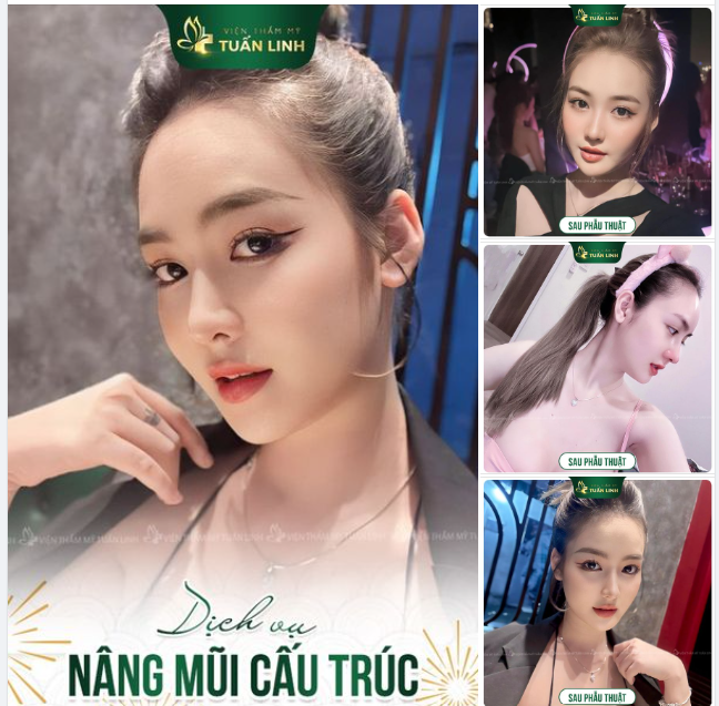 Feedback Dáng mũi sau 6 tháng nâng cấu trúc tại Tuấn Linh của cô nàng bị cả xóm nói '' mũi thế này rồi còn sửa làm gì nữa"...!