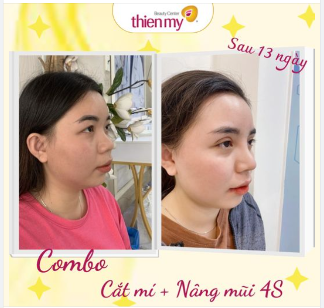 Chiếc ảnh xịn xò khách hàng thực hiện combo cắt mí kết hợp với nâng mũi 4S tại Thiện Mỹ.