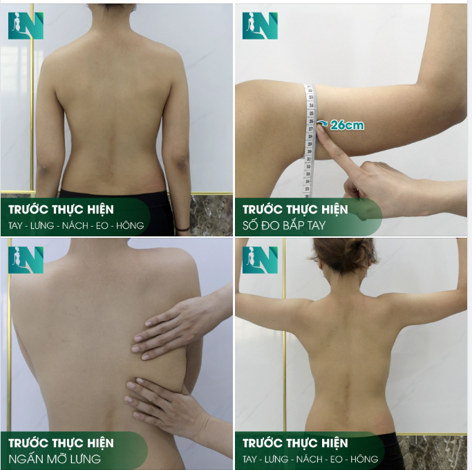 HÌNH ẢNH TRƯỚC KHI THỰC HIỆN HÚT MỠ TẠO DÁNG TAY - LƯNG - NÁCH VÀ EO - HÔNG