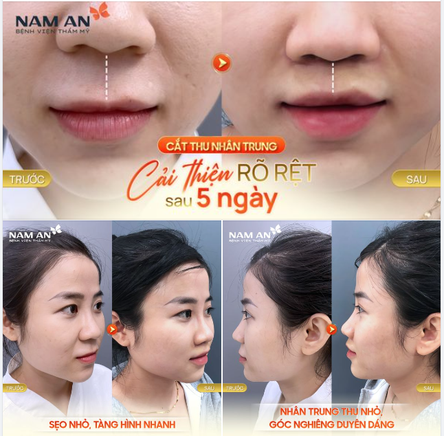 THU NGẮN NHÂN TRUNG - GIA TĂNG NHAN SẮC