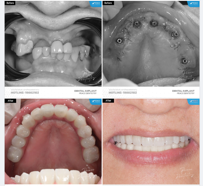ALL-ON-5 IMPLANT  IMPLANT TOÀN HÀM | PHỤC HÌNH TỨC THÌ