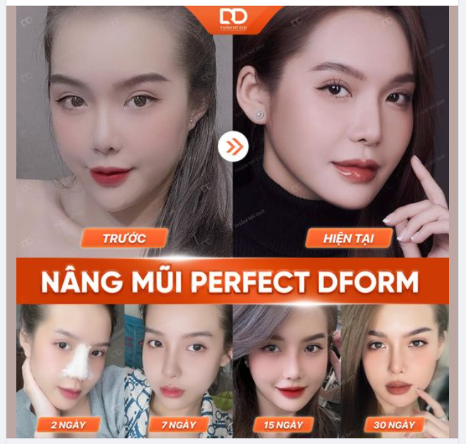 NÂNG MŨI CÓ MẤT THỜI GIAN NGHỈ DƯỠNG KHÔNG?