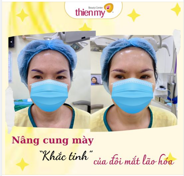 Chỉ 60 PHÚT thực hiện, dáng mày được đưa lên cao, giúp gương mặt trẻ trung hơn.