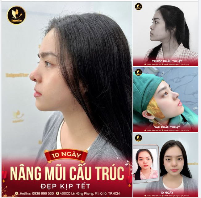 10 NGÀY NÂNG MŨI CẤU TRÚC ĐẸP KỊP TẾT