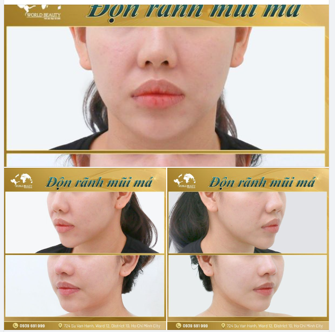 Ph.ẫu th.uật đ.ộn rãnh mũi-má là giải pháp thông qua đường mổ nhỏ để can thiệp vào bên trong khoang miệng, đặt vật liệu sụn vào để điều chỉnh sao cho làm đầy rãnh sâu của mũi-má.