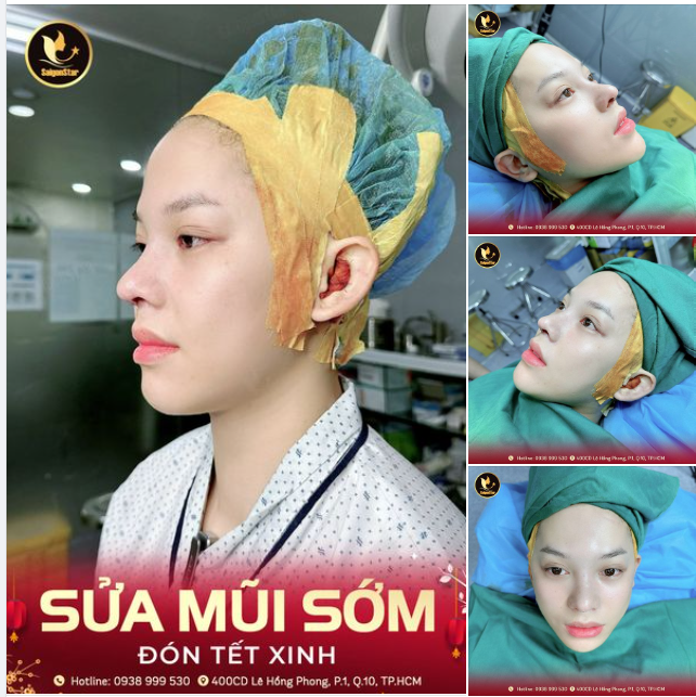 SỬA MŨI SỚM – ĐÓN TẾT XINH