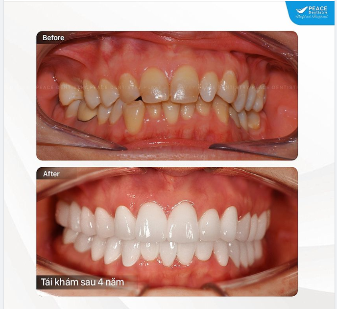 SÁT KHÍT, LIỀN LẠC & TÔN TRỌNG  KHOẢNG SINH HỌC CỦA NƯỚU KHI LÀM THẨM MỸ RĂNG SỨ