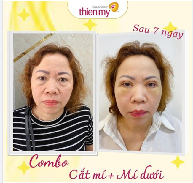 Combo trẻ hóa đôi mắt: Loại bỏ mỡ, da thừa mí trên tạo nếp mí mới rõ nét khắc phục tình trạng sụp mí mắt.