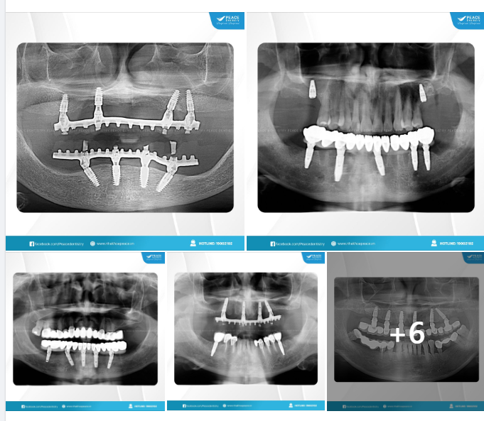 TRỒNG RĂNG IMPLANT TOÀN HÀM