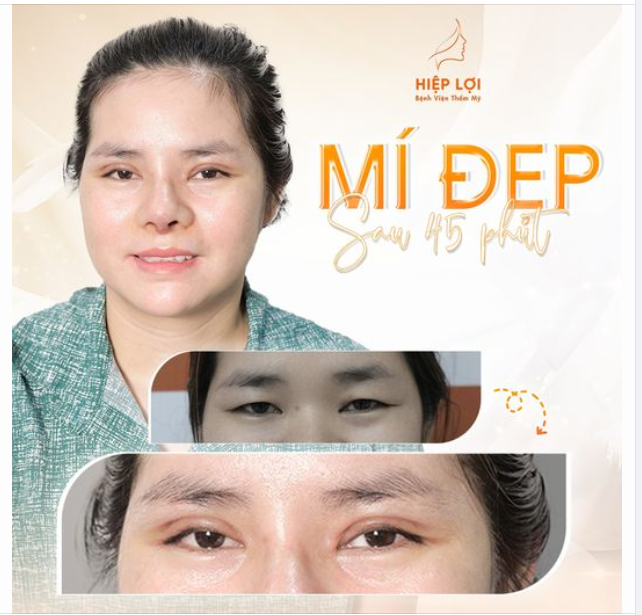 "MÍ LÓT, MÍ SỤP" biến hóa thành nếp mí "TỰ NHIÊN" - Chỉ sau 45 phút