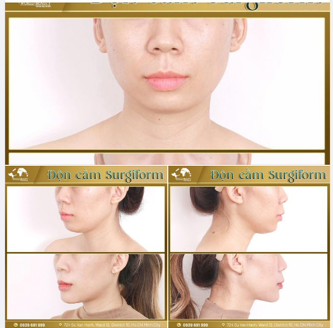Sở hữu dáng CẰM V.line thời thượng, lâu dài bằng ph.ẫu th.uật Độn cằm sụn Surgiform