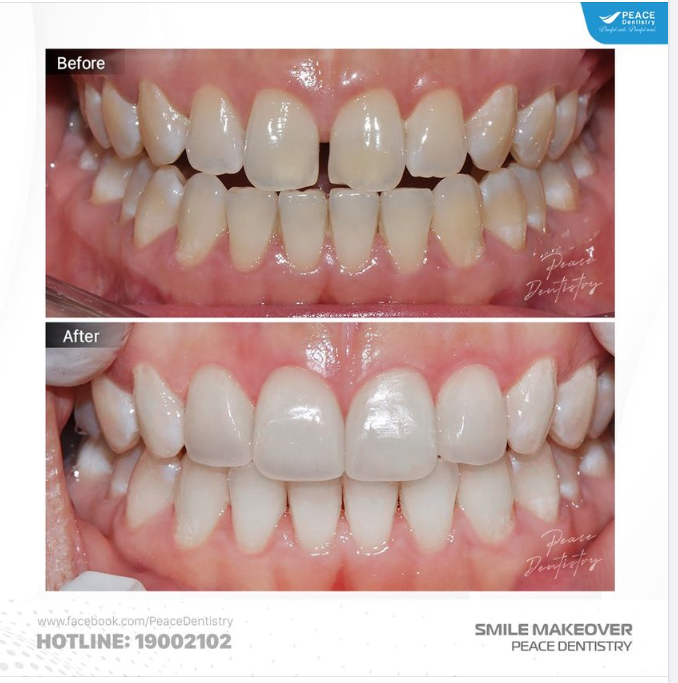 VENEER SỨ ĐÓNG KÍN KHE THƯA  TÁI KHÁM SAU 1 NĂM