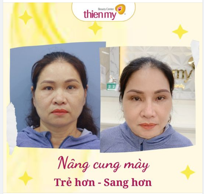 Các yếu tố ảnh hưởng tới quá trình lành thương khi nâng cung mày: