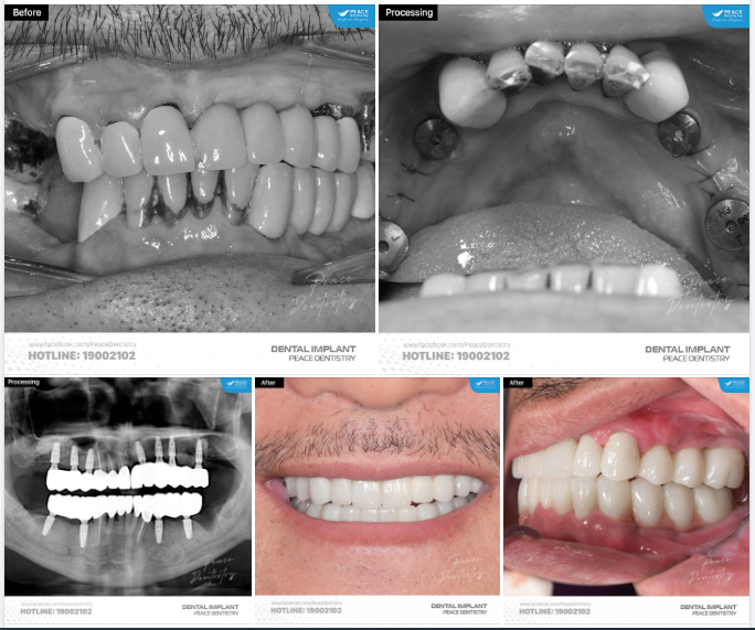 IMPLANT  KHÁCH HÀNG VIỆT KIỀU