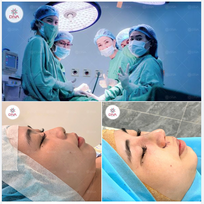 ĐÓN TẾT VỚI DÁNG MŨI CAO HÀI HÒA, THANH THOÁT THU HÚT - TẠI SAO KHÔNG?
