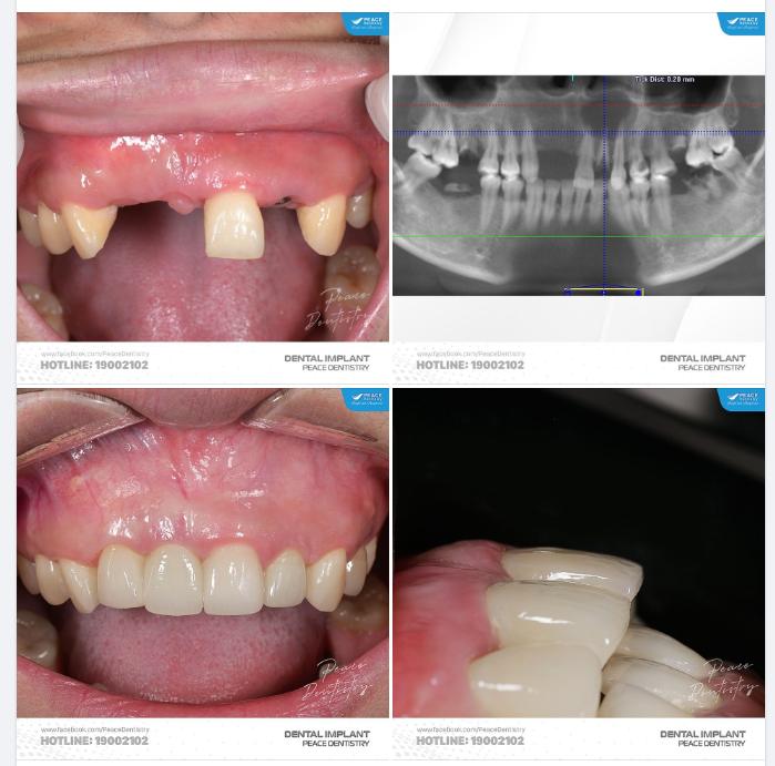 Ca lâm sàng implant có ghép xương, ghép nướu cho vùng răng cửa