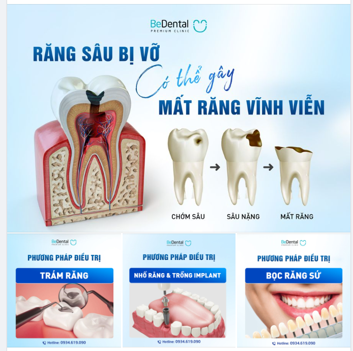 SÂU RĂNG CÓ THỂ DẪN TỚI MẤT RĂNG VĨNH VIỄN