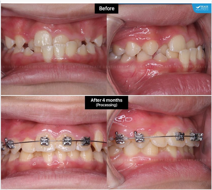 ORTHODONTICS  PROCESSING  AFTER 4 MONTHS