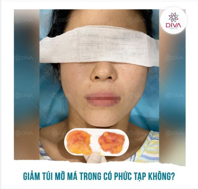 GIẢM MỠ MÁ TRONG CÓ PHỨC TẠP KHÔNG?