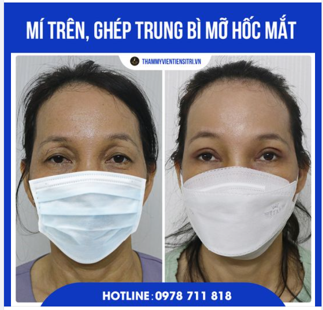 CẢI THIỆN HỐC MẮT SÂU Nhờ: Mí Trên, Ghép Trung Bì Mỡ Hốc Mắt