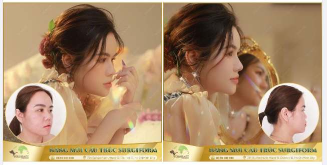 Hiện thực hóa GÓC NGHIÊNG CHUẨN TỶ LỆ VÀNG giúp quý Cô bằng giải pháp N.âng mũi cấu trúc tại sao không?