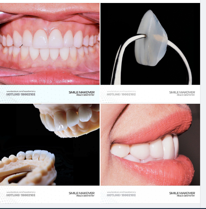 Vật liệu veneer: IPS e.Max (một loại vật liệu sứ thủy tinh nổi tiếng hàng đầu thế giới của hãng Ivoclar Vivadent).