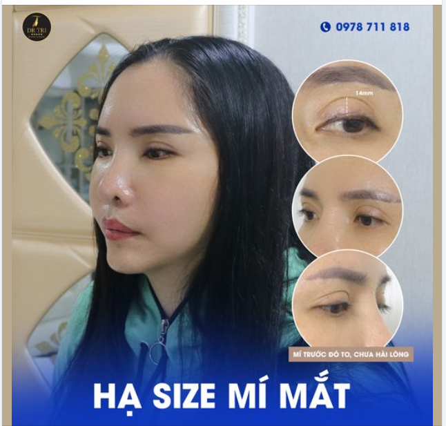 Phẫu Thuật Hạ Size Mí Mắt. Sự kết hợp giữ Y Học và Nghệ Thuật