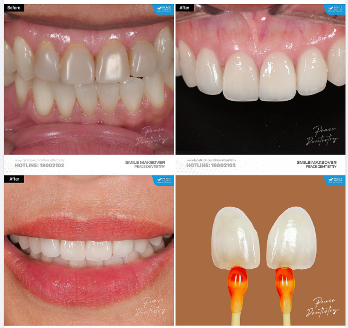 SMILE MAKEOVER  PORCELAIN VENEER