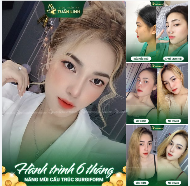 Sụn Surgiform luôn là lựa chọn hàng đầu cho dáng mũi bền đẹp dài lâu!!