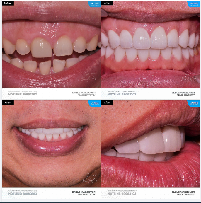 Ca lâm sàng  cắt nướu và  dán mặt sứ veneer để thiết kế nụ cười toàn diện cho khách hàng trẻ tuổi