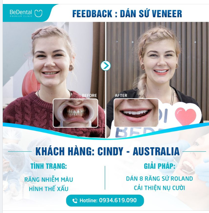 RĂNG SỨ THẨM MỸ - GIẢI PHÁP LÀM ĐẸP NỤ CƯỜI HIỆU QUẢ