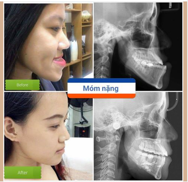 Kết Quả Sau 07 Ngày Phẫu Thuật Cho Ca Móm Nặng. Chỉ 2cm - Nhưng thay đổi cả một đời người