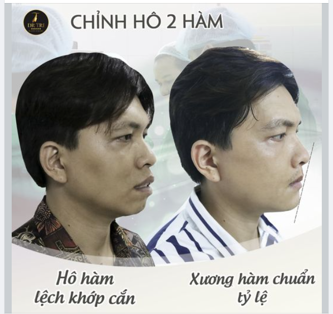 Kết Quả Sau 03 Ngày Chỉnh Hô 02 Hàm​​​​​​​. Ưu Đãi 30% Cho 12 Khách Hàng Trong Dịp Tết