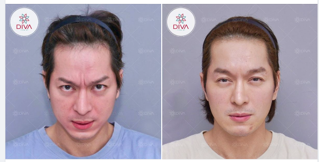 XÓA NẾP NHĂN GIAN MÀY VỚI PHƯƠNG PHÁP TIÊM BOTOX
