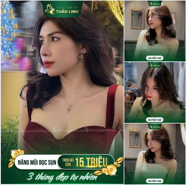 NÂNG MŨI BỌC SỤN - TRỌN GÓI 15 TRIỆU - CÓ TRẢ GÓP